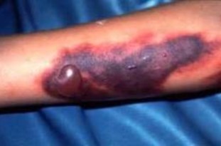 هیچ مورد «تب کریمه» در آذربایجان‌شرقی گزارش نشده است